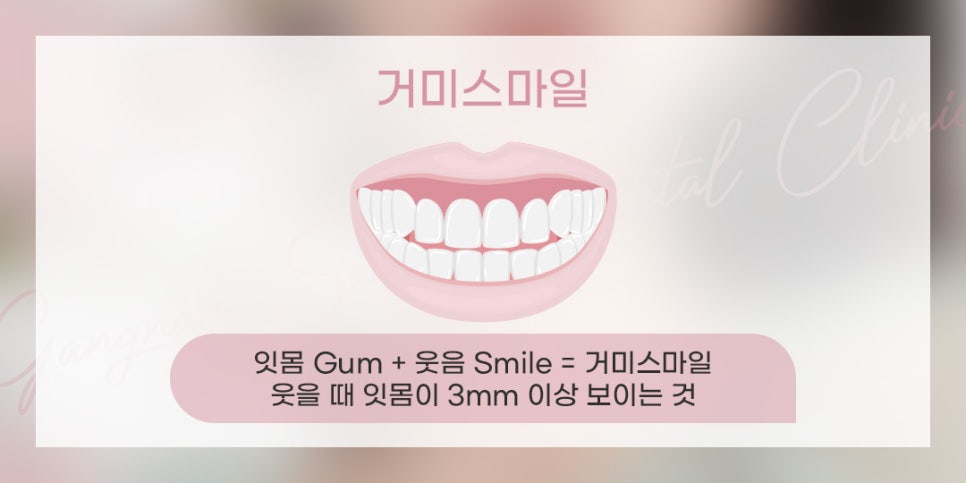 잇몸돌출교정 잇몸성형 수술 비수술 (잇몸돌출) 관련 이미지 2