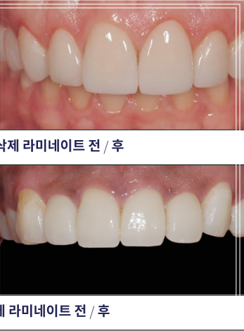 헨리라미네이트, 치아 손상없이 안전하게 진행 관련 이미지 12