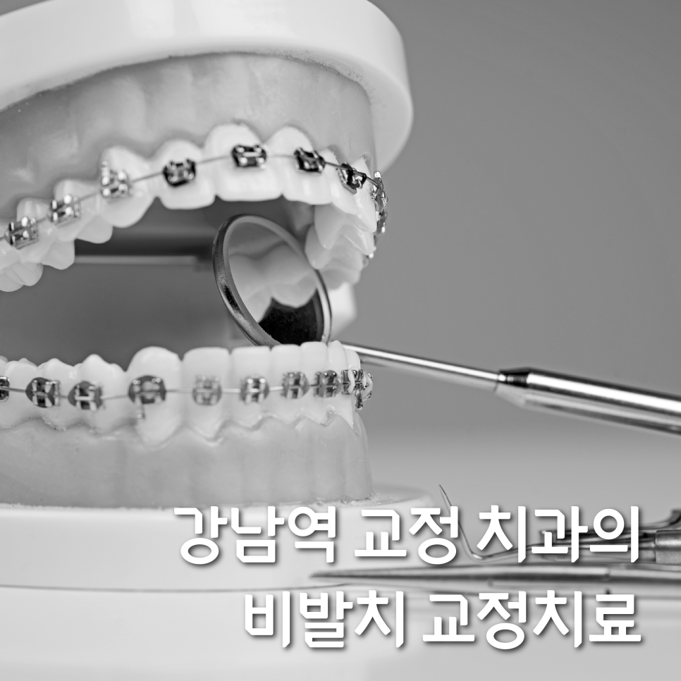 강남역교정치과를 찾고 계신다면? 비발치로 해결하세요! 관련 이미지 1
