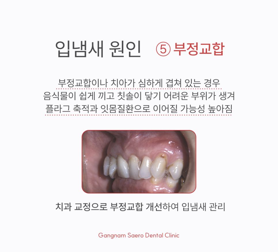 Bad Breath Clinic: What If You Have Bad Breath Even Though You Brush Regularly? image 8