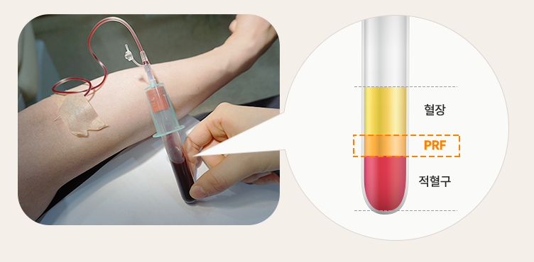 당뇨, 고혈압, 골다공증 환자 맞춤형 (PRF임플란트 자가혈임플란트) 관련 이미지 1