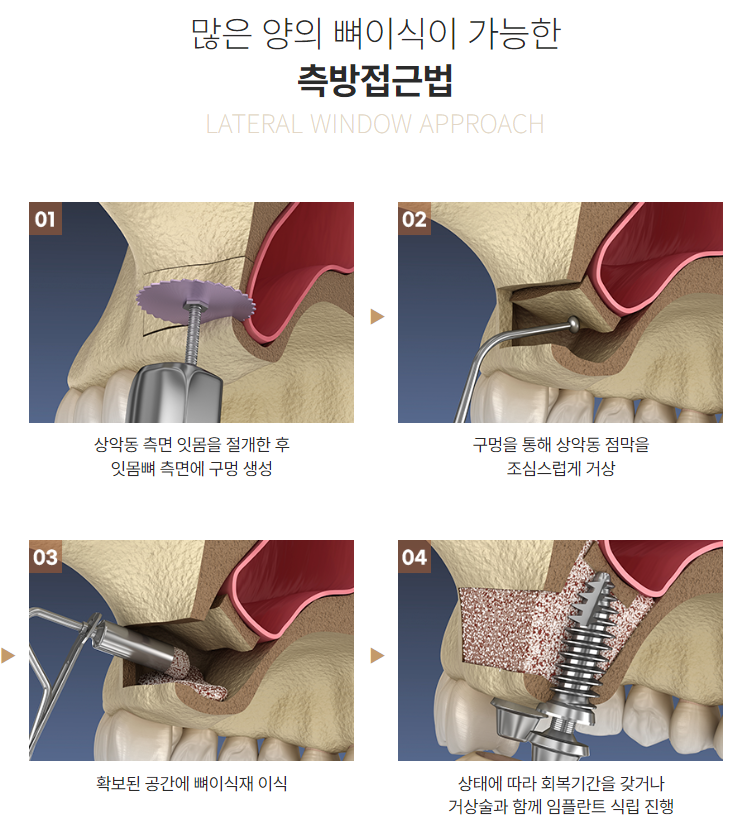 최소식립 65세 70대 임플란트 (전체임플란트) 관련 이미지 3
