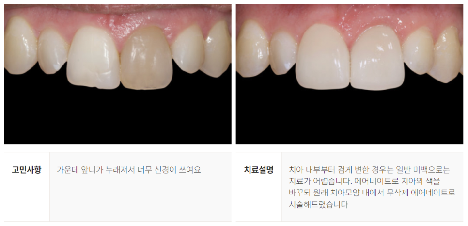 강남역 라미네이트대체 시술 (에어네이트) 관련 이미지 10