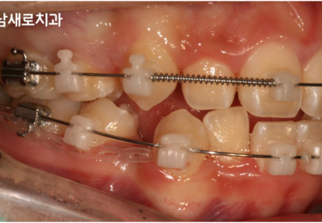 비발치교정 치료, 발치 없이 진행하는 과정 관련 이미지 4