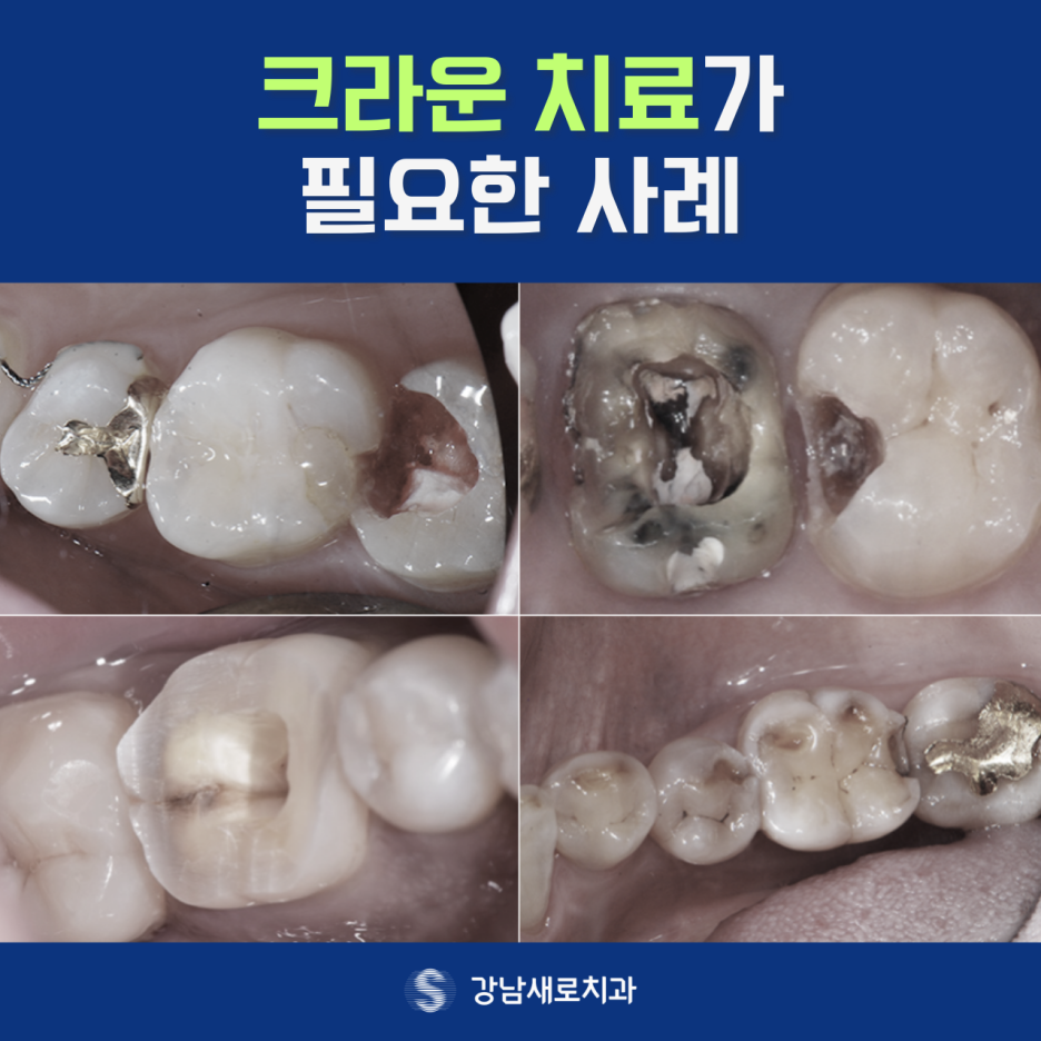 치아파손치료가 필요한 대상과 증상 및 진료 과정 관련 이미지 4