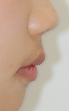 콤플렉스인 뻐드렁니 돌출입 교정으로 개선이 가능할까? 관련 이미지 3