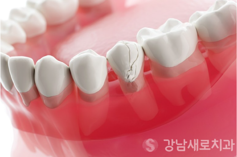 송곳니덧니교정, 방치하면 부작용이 발생한다? 관련 이미지 10