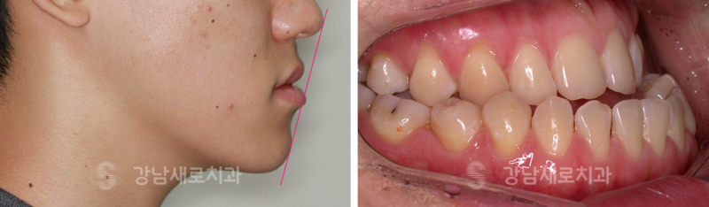 어린이주걱턱교정, 성장기전 빠른 시일내에 진행해야 하는 이유? 관련 이미지 3