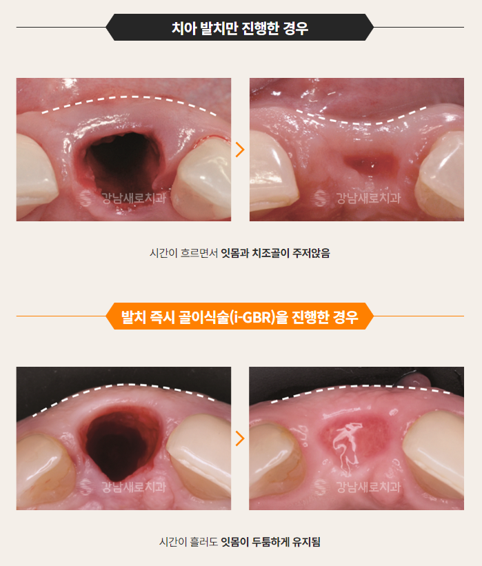 임플란트 성공률 수술 전 살펴봐야할 것 (임플란트주의사항) 관련 이미지 8