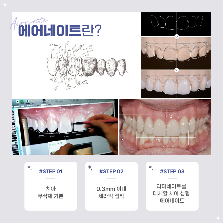 강남역 라미네이트대체 시술 (에어네이트) 관련 이미지 6