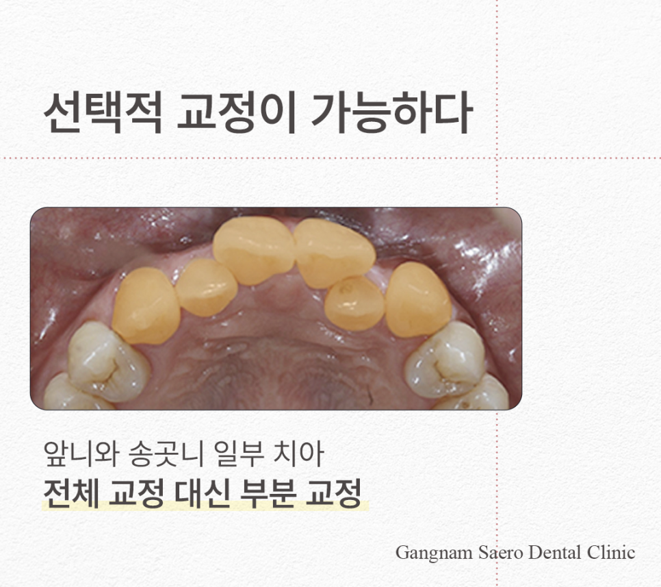 치아 일부만 교정하고 싶다면 비용과 시간을 절약하는 (급속부분교정) 관련 이미지 4