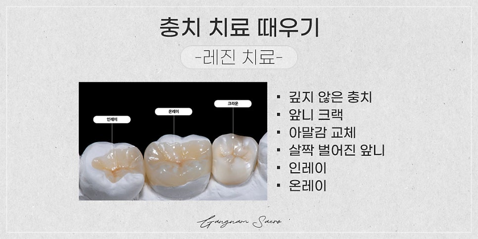 충치 치료 방법 때우기 씌우기 임플란트 (충치치료임플란트) 관련 이미지 2