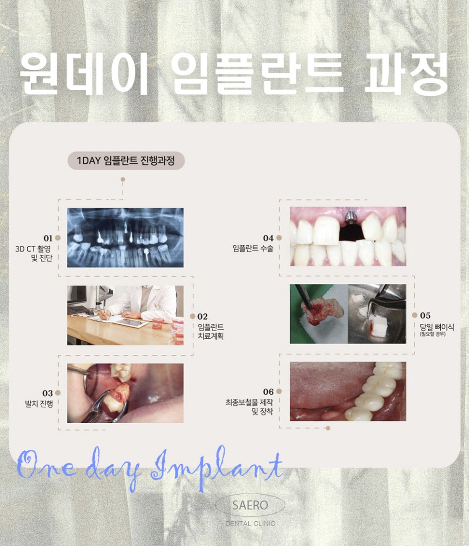 발치부터 임플란트까지 6개월 단축 (원데이임플란트) 관련 이미지 5