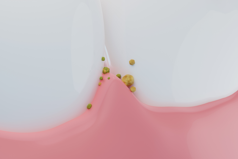잇몸에서 피가 난다면, 관련 이미지 5