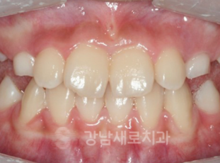 유아 주걱턱교정, 올바른 뼈 성장을 위한 방법 관련 이미지 9