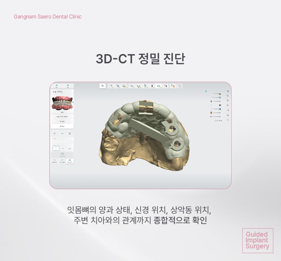 Implants with Less Swelling and Pain Burden (Navigation-Guided Implants) image 3