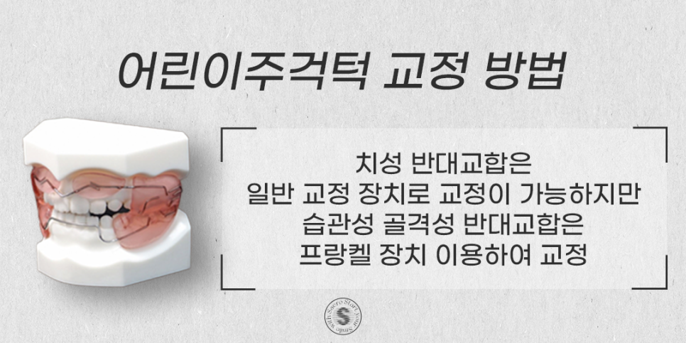 주걱턱은 조기 치료가 핵심 (어린이주걱턱교정) 관련 이미지 3