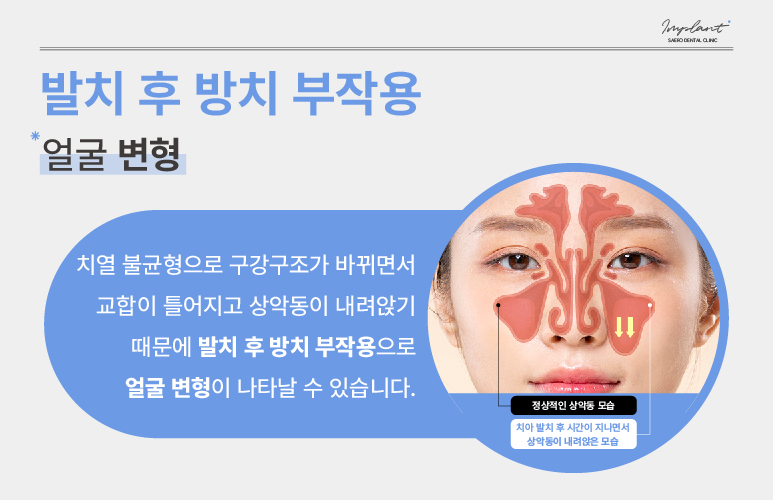 발치 후 임플란트 해야 하는 이유 (임플란트안하면) 관련 이미지 5