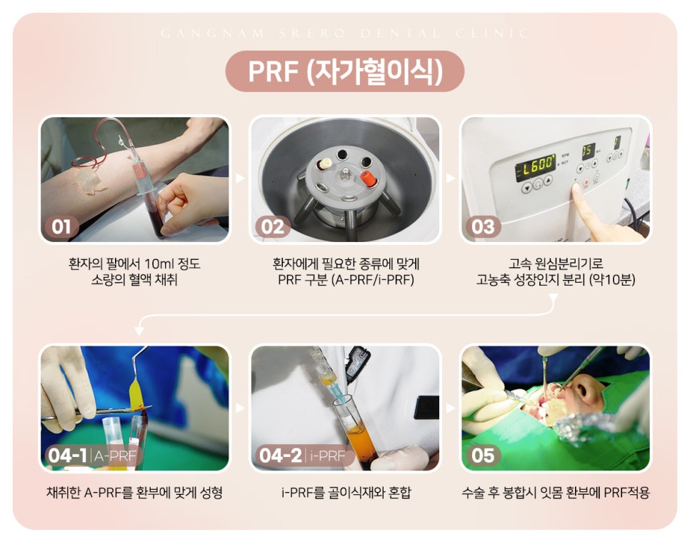 임플란트 부작용 자세히 알아보기(3) 임플란트 치주조직손상 부작용 [ 예방 및 대처 방법 ] [ 강남새로치과 ] 관련 이미지 7