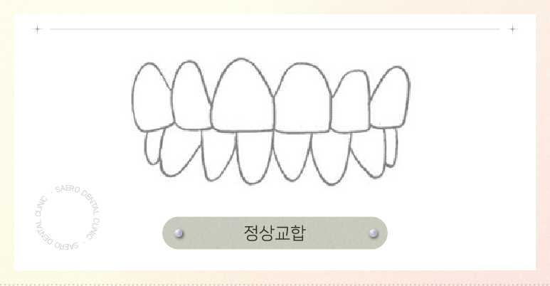 부정교합 투명교정으로 교정이 되나요? (부정교합교정) 관련 이미지 3