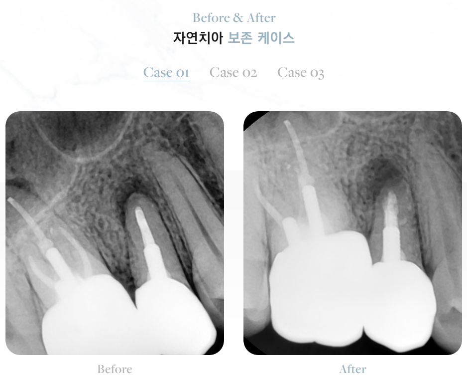충치때우기 충치씌우기 차이, 크라운을 미루면 임플란트까지?! 관련 이미지 8