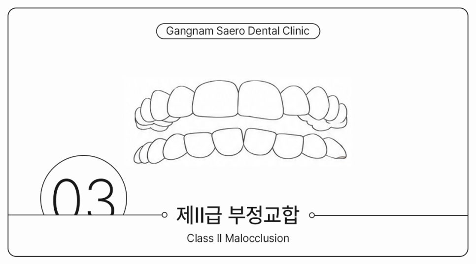부정교합 개방교합 과개교합 투명교정으로 가능할까요? (주걱턱교정기 돌출입교정기) 관련 이미지 5
