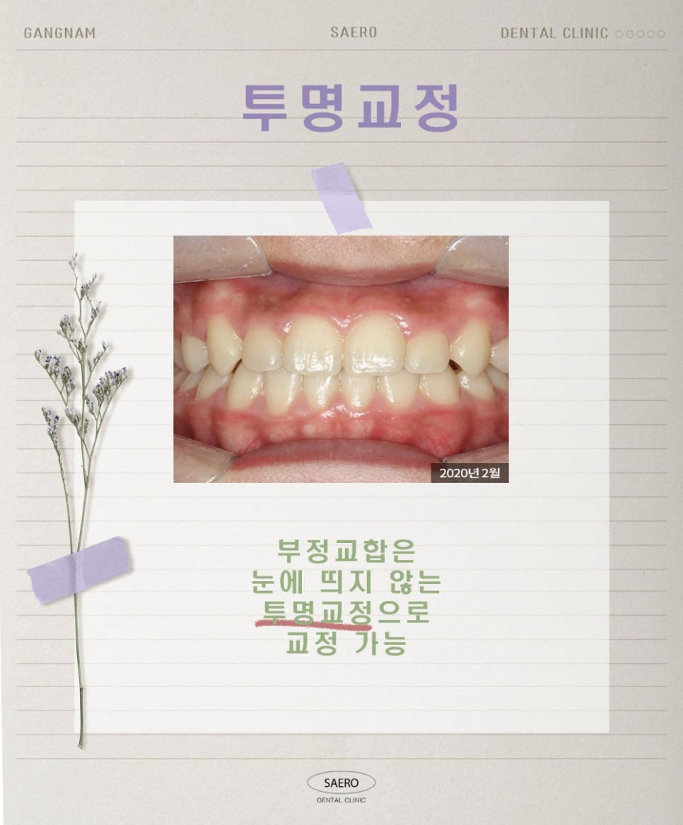 양치질을 해도 입냄새가 난다면 (구취 원인과 해결법) 관련 이미지 9