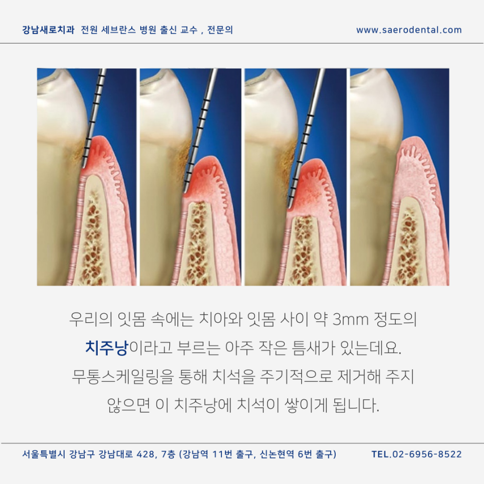 무통스케일링, 관련 이미지 4