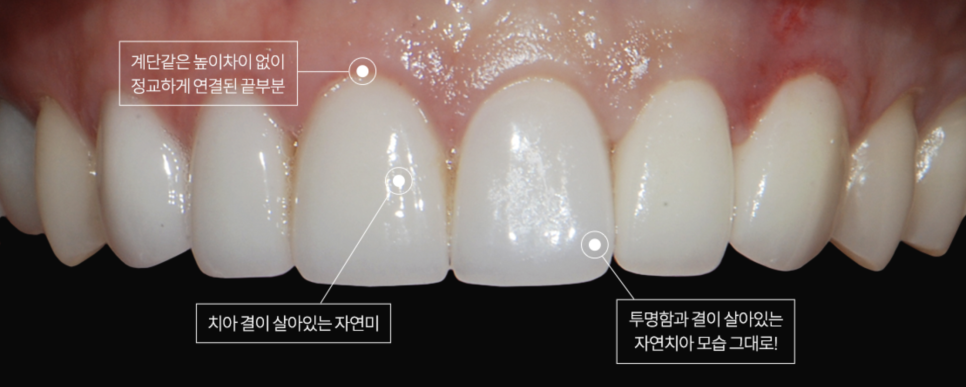 강남역라미네이트, 부작용을 최소화하는 방법? 관련 이미지 5