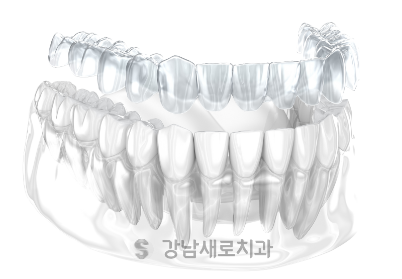 강남투명교정, 강남새로치과 나노라이너의 차별점 관련 이미지 8