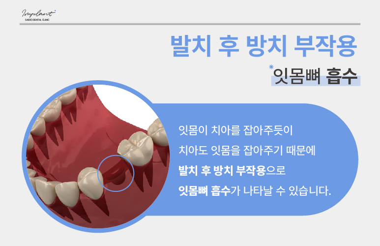 발치 후 임플란트 해야 하는 이유 (임플란트안하면) 관련 이미지 2