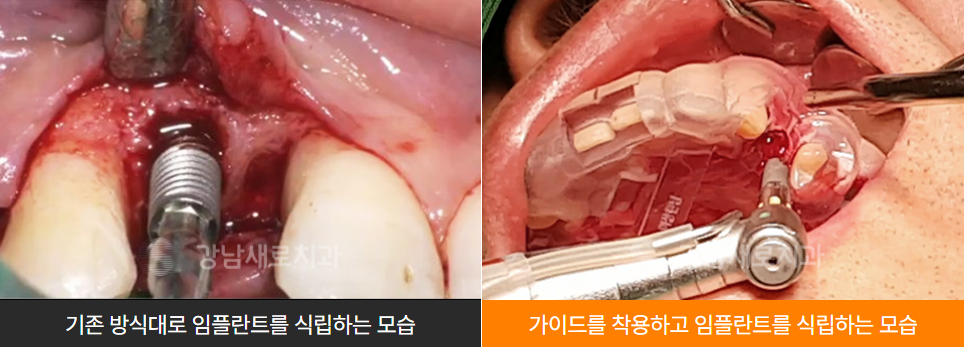 임플란트붓기 출혈 통증 걱정된다면 (네비게이션 임플란트) 관련 이미지 3