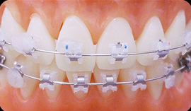 클리피씨가 뭔가요? 데이몬 클리어는 뭔가요? (자가결찰교정종류) 관련 이미지 3