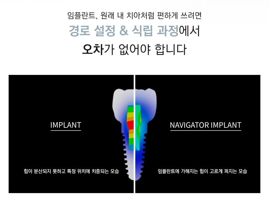 임플란트부작용 (통증, 붓기) 최소화할 수 있는 (네비게이션임플란트) 관련 이미지 2