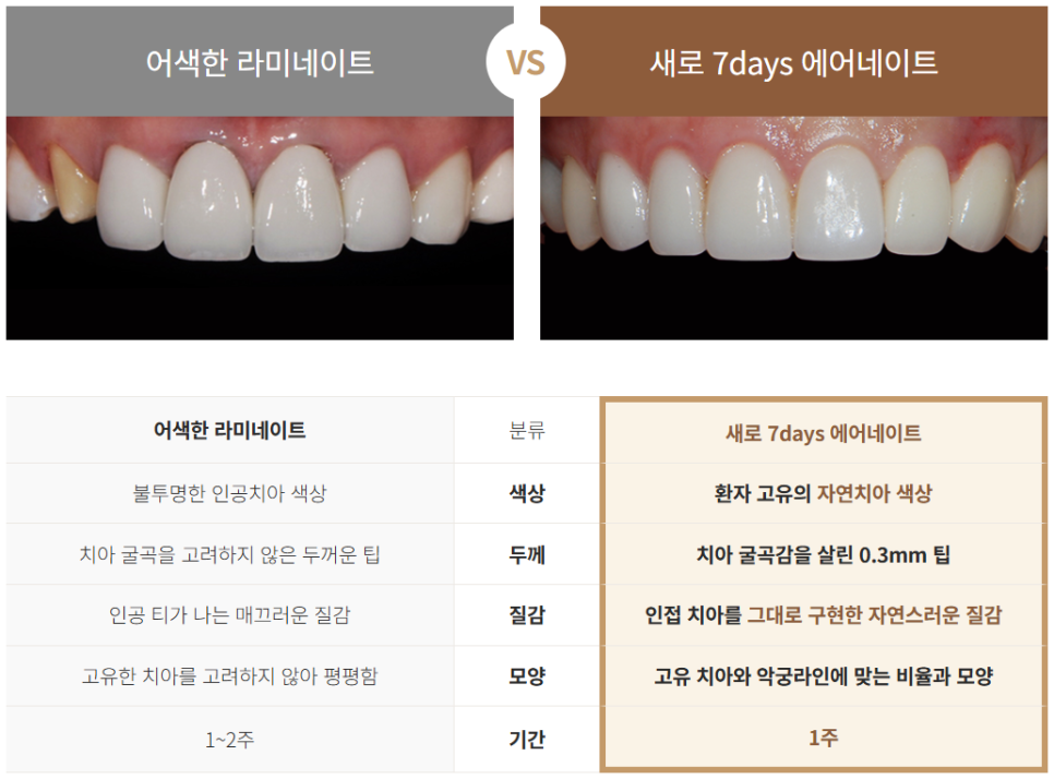 미백 시술 말고 누런이 해결할 수 있는 방법은? (무삭제라미네이트) 관련 이미지 5