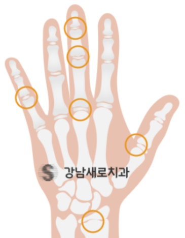 유아 주걱턱교정, 올바른 뼈 성장을 위한 방법 관련 이미지 10