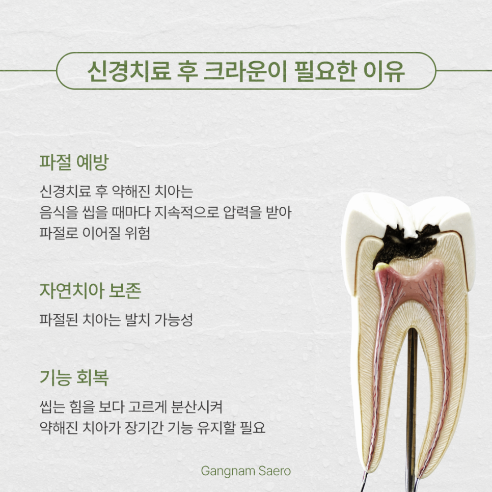 After Root Canal Treatment, Is a Crown Really Necessary? (Dental Crown) image 2