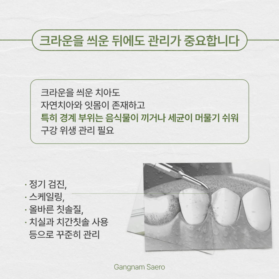 After Root Canal Treatment, Is a Crown Really Necessary? (Dental Crown) image 5