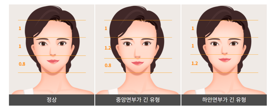 성인 주걱턱 교정 가능합니다! 양악 교정에 대해 알아봅시다! 관련 이미지 2