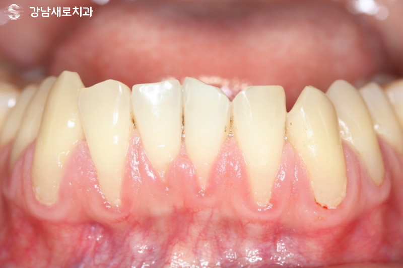 강남역잇몸염증치료, 잇몸피가 나는 원인의 치료방법? 관련 이미지 7