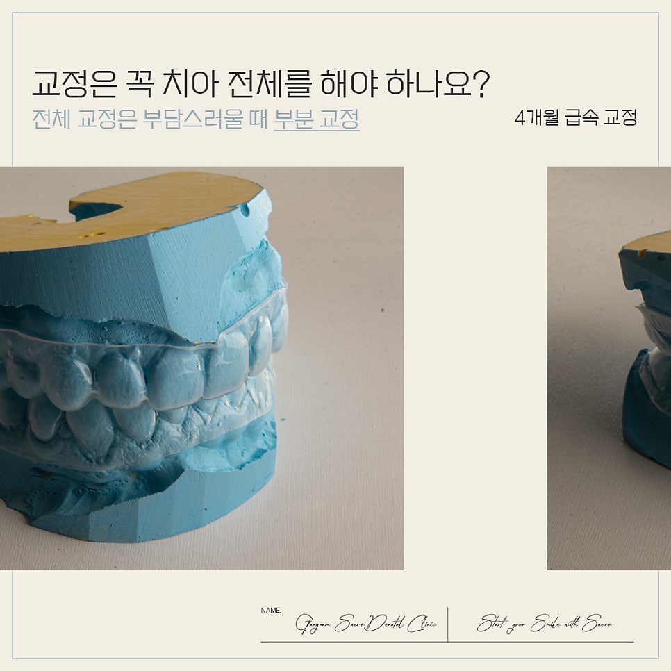 4개월이면 치료 종료되는 급속교정 (강남역부분교정) 관련 이미지 1