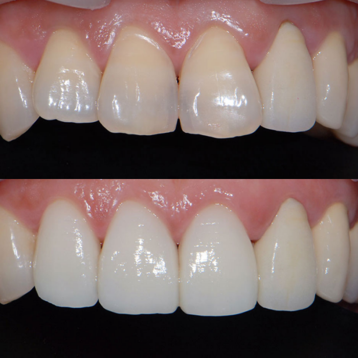 법랑질 삭제를 최소로 하는 헨리라미네이트 관련 이미지 3