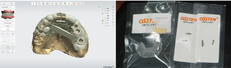 임플란트부작용 걱정된다면 강남새로치과 네비게이션 임플란트 (임플란트통증) 관련 이미지 6