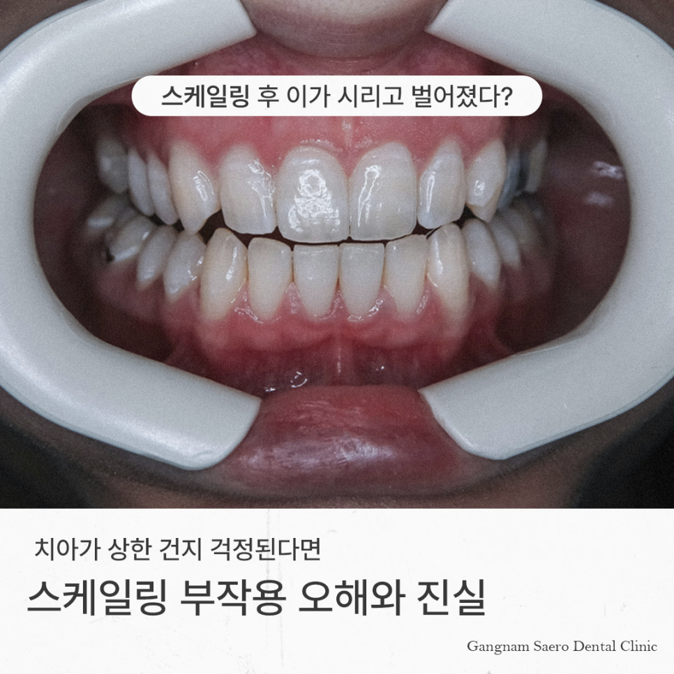 스케일링 후 이가 시리고 벌어졌다? 스케일링부작용 오해와 진실 관련 이미지 1