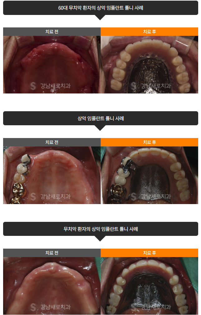 전체임플란트 틀니 중 고민 중이라면 (임플란트틀니) 관련 이미지 7