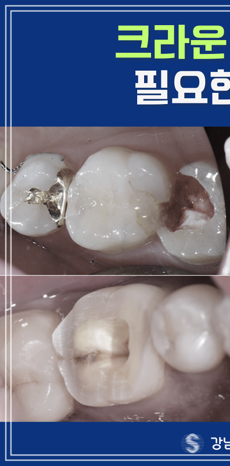 탕후루 치아 손상을 유발? 치료 방법 및 후기 관련 이미지 10