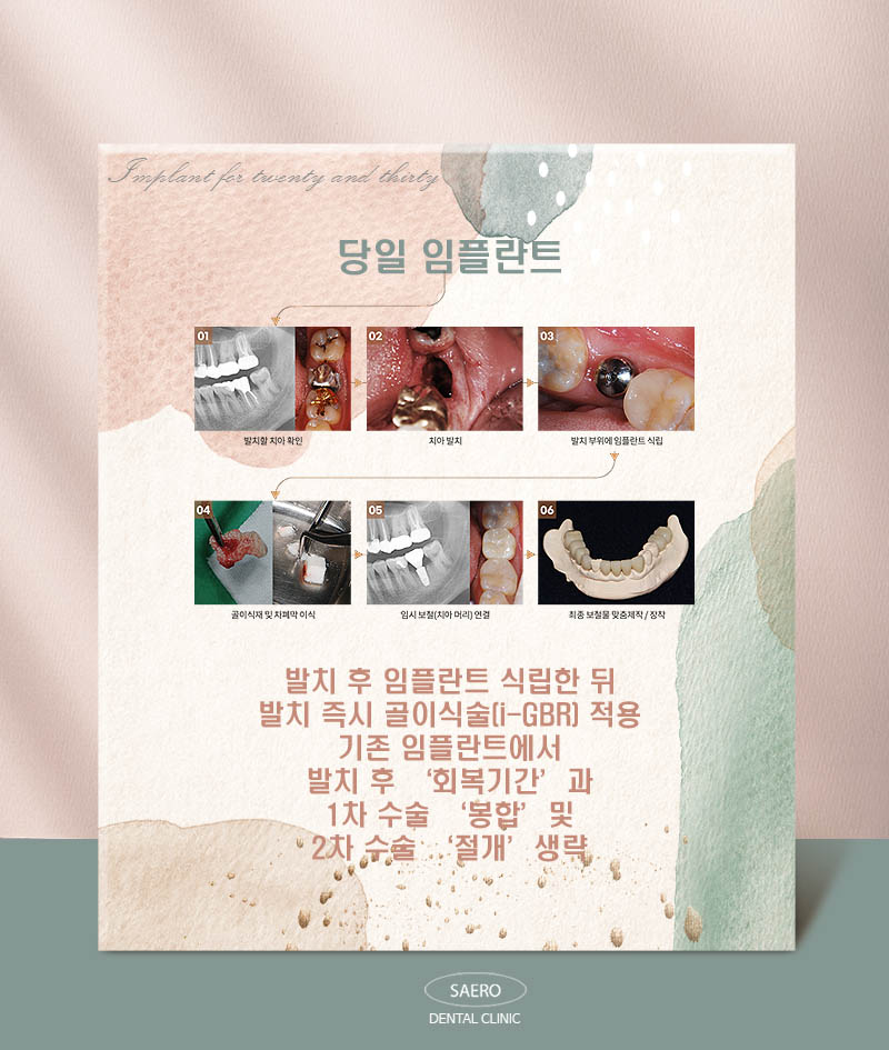 MZ세대 2030을 위한 임플란트 (당일임플란트) 관련 이미지 4