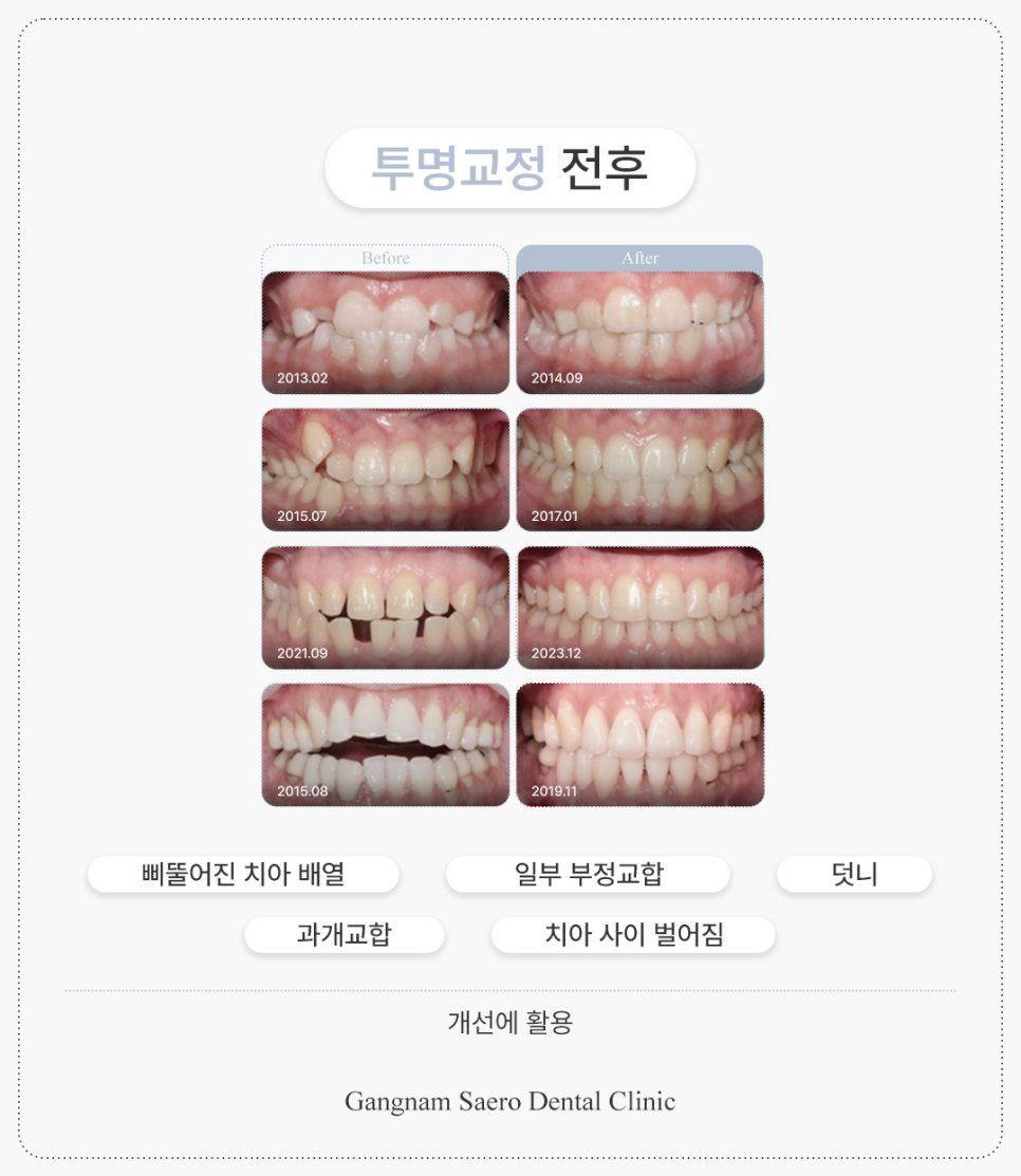 투명교정효과 투명교정후기 투명교정전후 관련 이미지 4