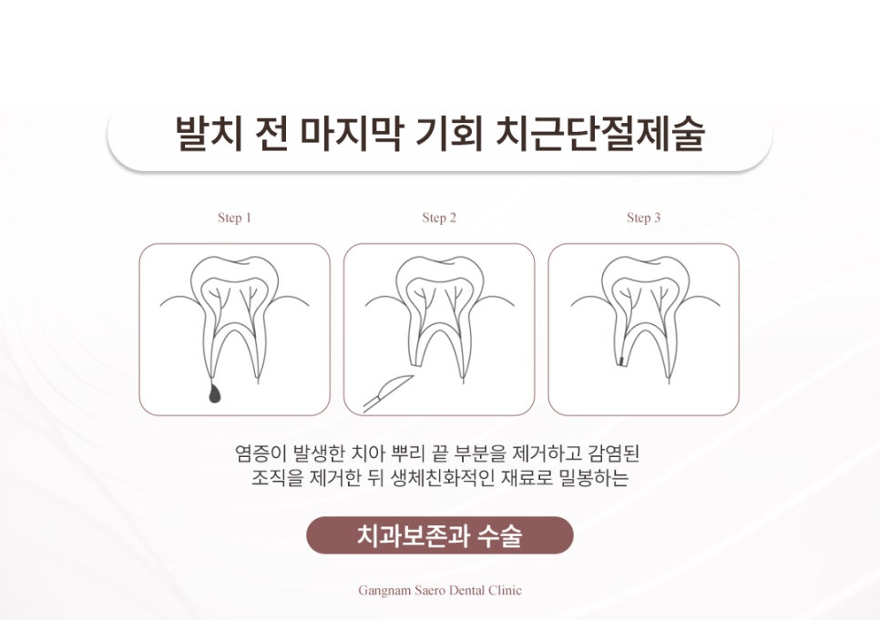 What If Your Dentist Says a Severely Decayed Tooth Needs to Be Extracted? (Reasons for Extraction Due to Tooth Decay) image 4