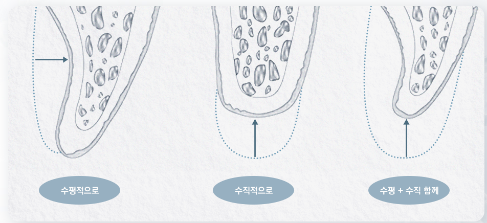 Dental Implant Side Effects: Gums (Periodontal and Gum Tissue Damage) — Prevention and Management image 3